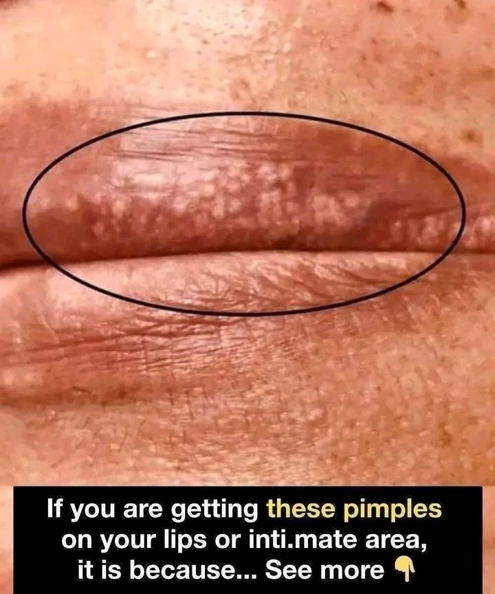 If you are getting these pimples on your lips or int;im:ate area, it is because…