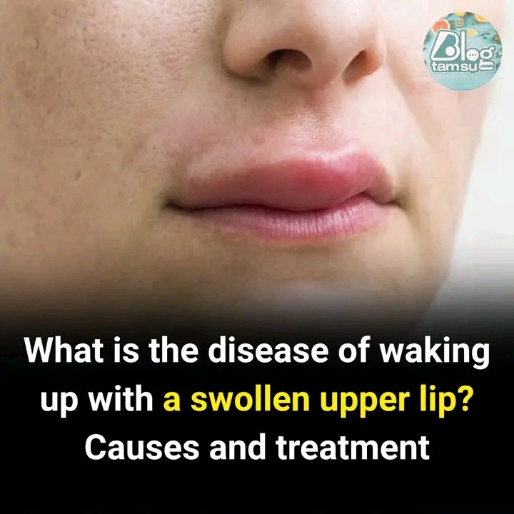Waking Up With a Swollen Upper Lip: What You Should Know