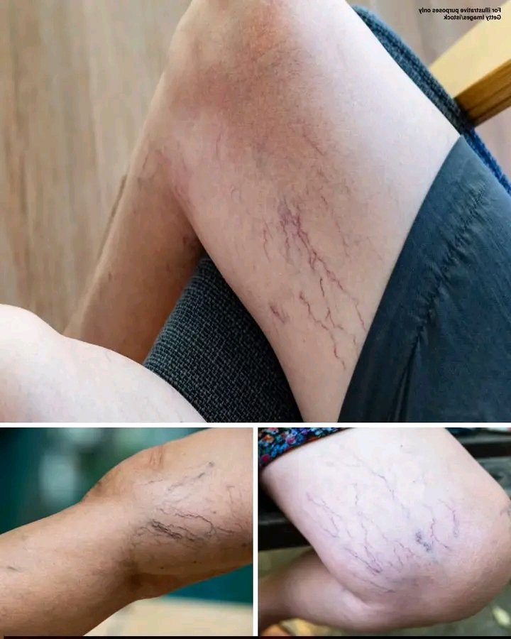 If You Have Purple Veins on Your Legs, What Does It Mean?