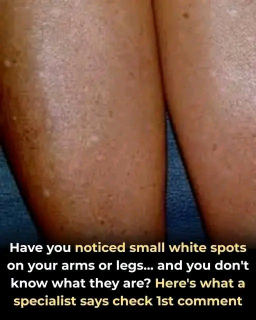 Have you noticed small white spots on your arms or legs, and you do not know what they are? Here’s what a specialist says,..