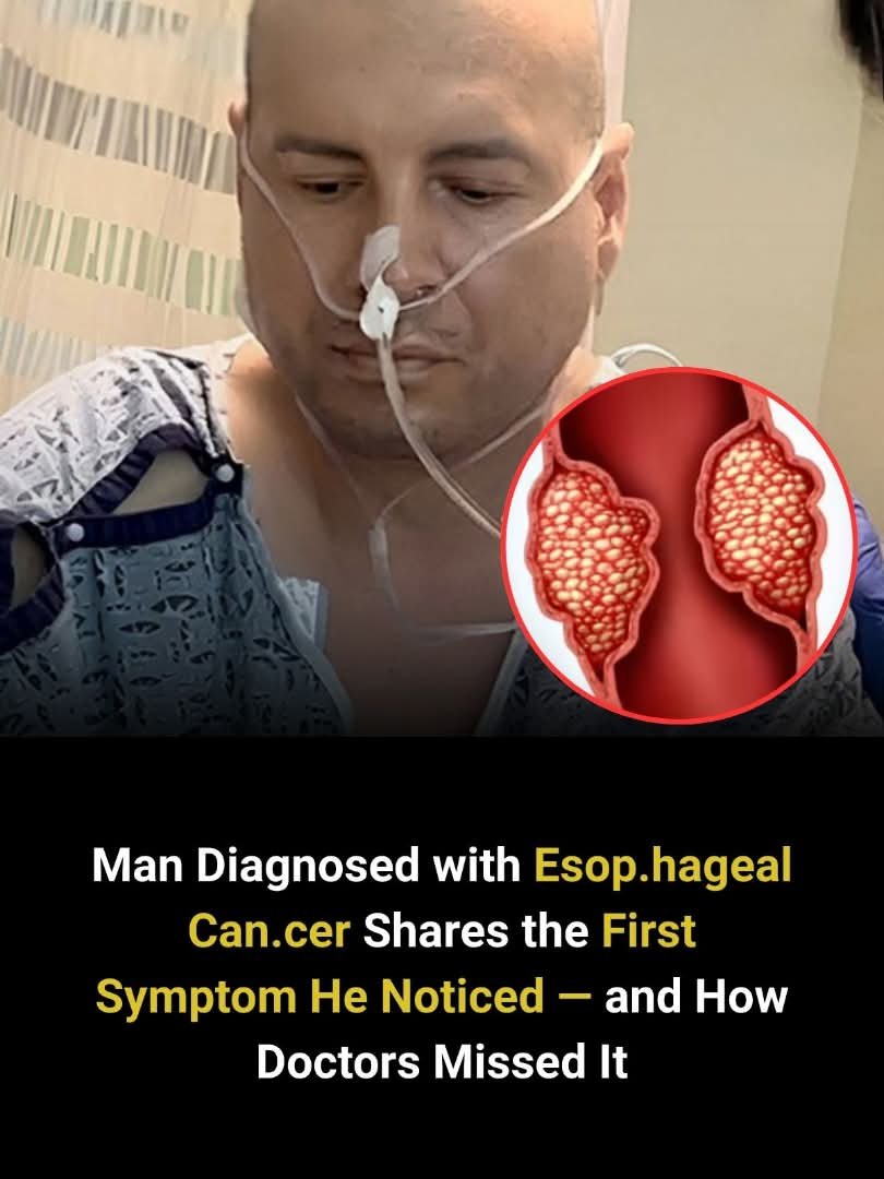 Common sign of esoph.ageal can.cer most people miss.