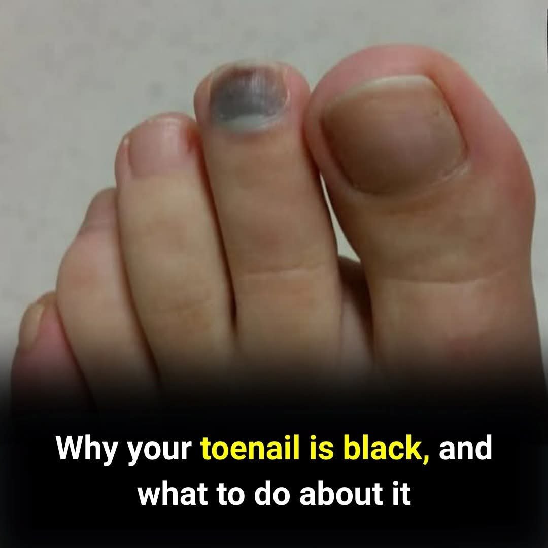 🦶⚠️ What a Black Toenail Could Signal — and When to Worry