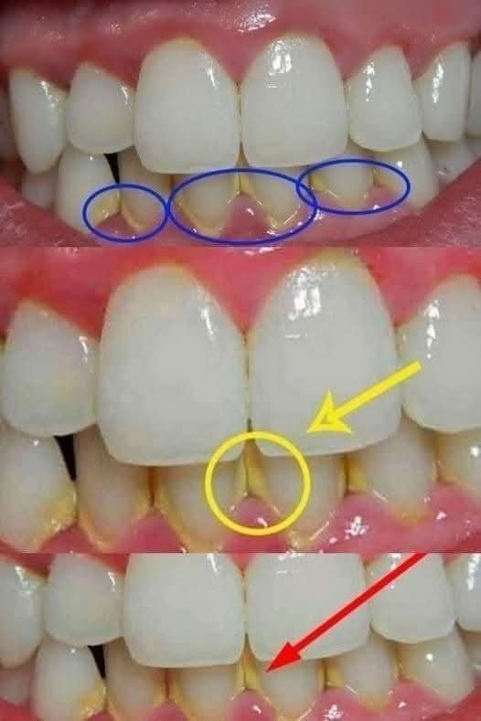 in two minutes remove 10 years of stains from teeth!! Results will Shock You