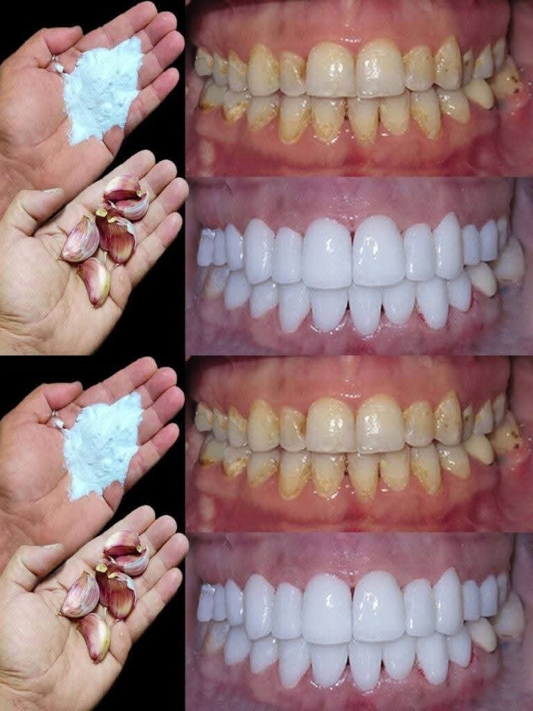 Home Teeth Whitening: Get Whiter Teeth in Just 2 Minutes!