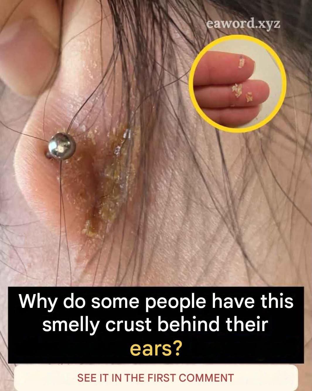 If You Have Scabs Behind Your Ears, It Definitely Means You Have…?