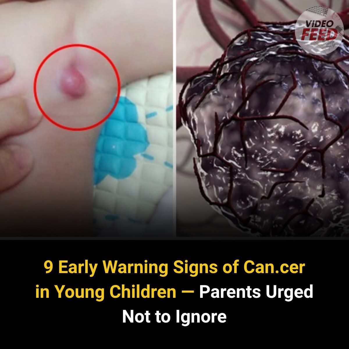 9 early warning signs of cancer in young children- Every parents should know…see more