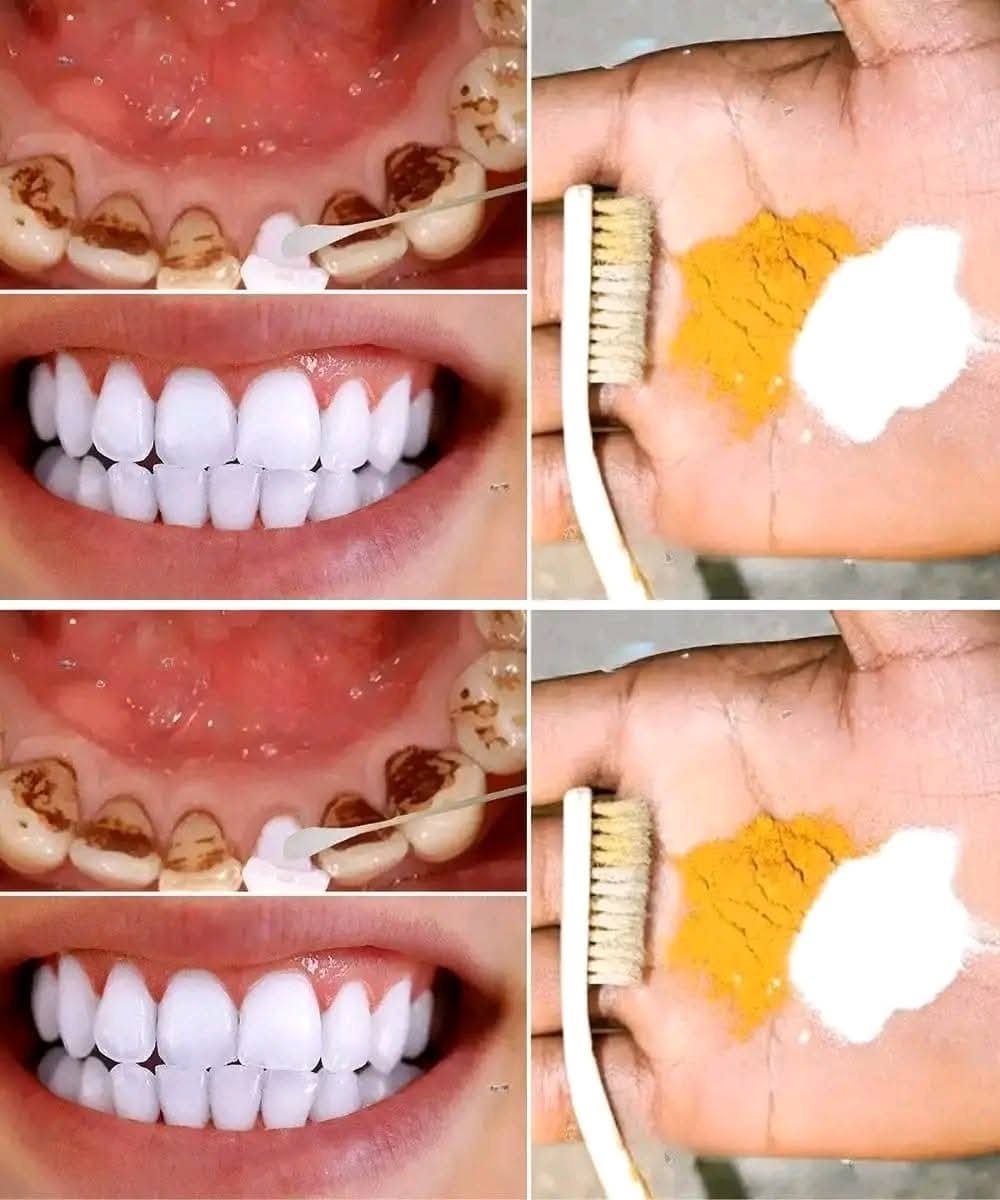 Home Teeth Whitening: Can You Really Get Whiter Teeth in Just 2 Minutes?