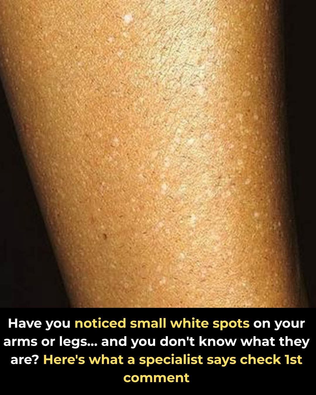 Have you noticed small white spots on your arms or legs… and you don’t know what they are?